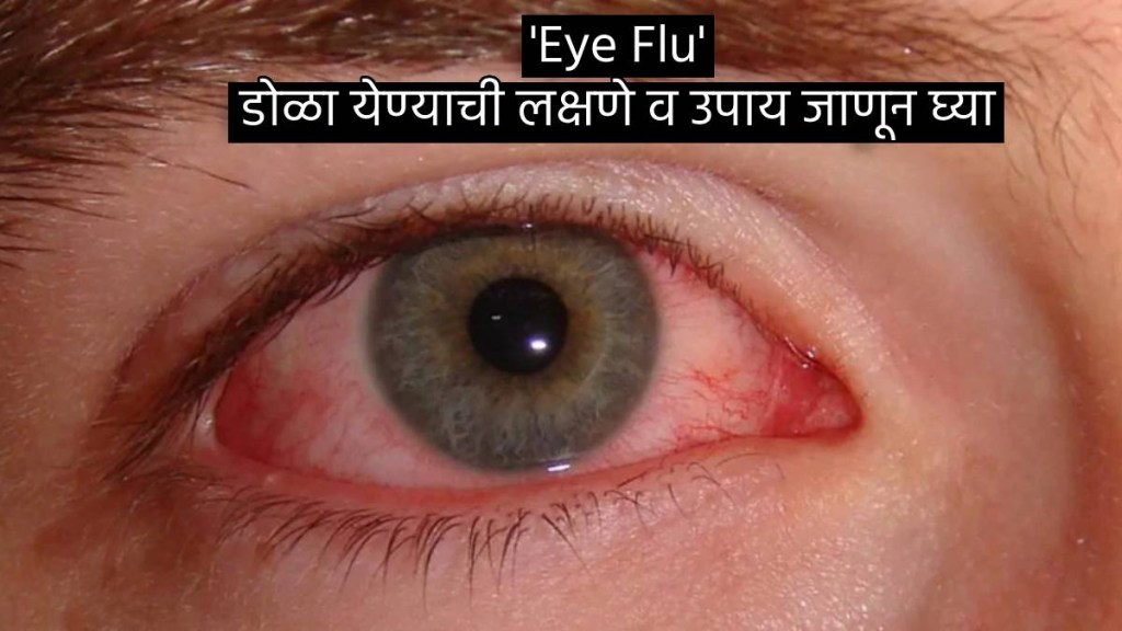 Eye Flu Conjunctivitis Treatment what cause Dola yene Red eyes Burning and Itching Puss in Eyes Check home Remedies and Signs