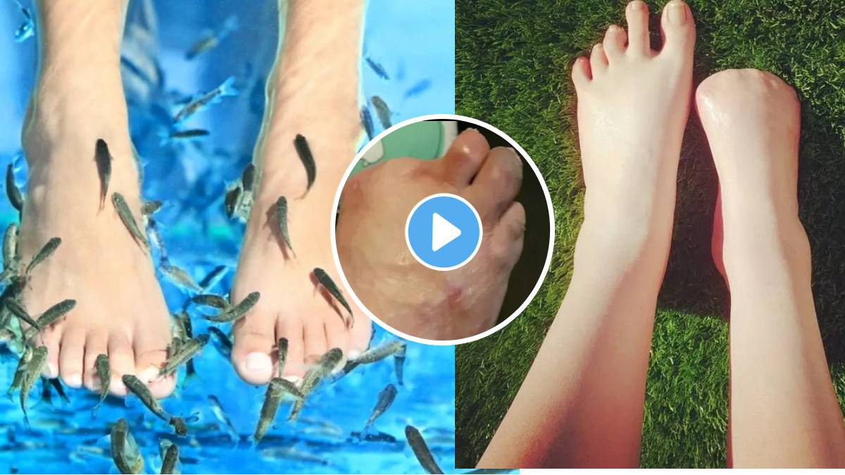 Girl Has All Five Toes On Her Right Foot Amputated After Catching A 'bone eating Infection From A Thai FISH SPA' infected Thai fish tank at spa leaves her with horrific injuries