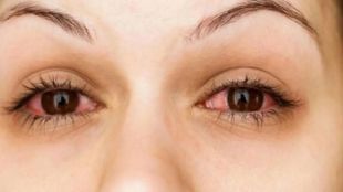 eye disease in state