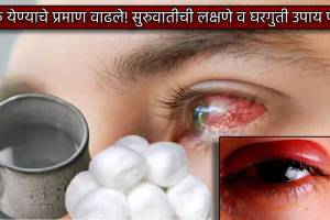 Dole Yene Conjunctivitis First Signs Home Treatment Which Eyedrop Should Be Used To Reduce Eyes Burning Things Keep Mind