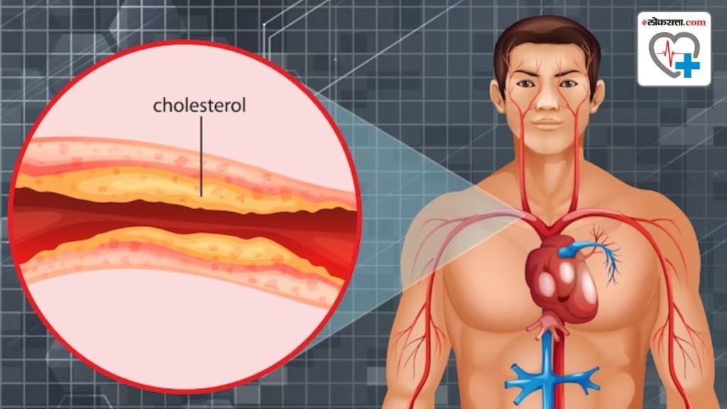 High LDL cholesterol management