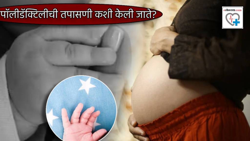Baby Girl With 26 Fingers and Toes Family Shocked Started Worshipping Doctor Explain Polydactyly Condition Signs Treatment