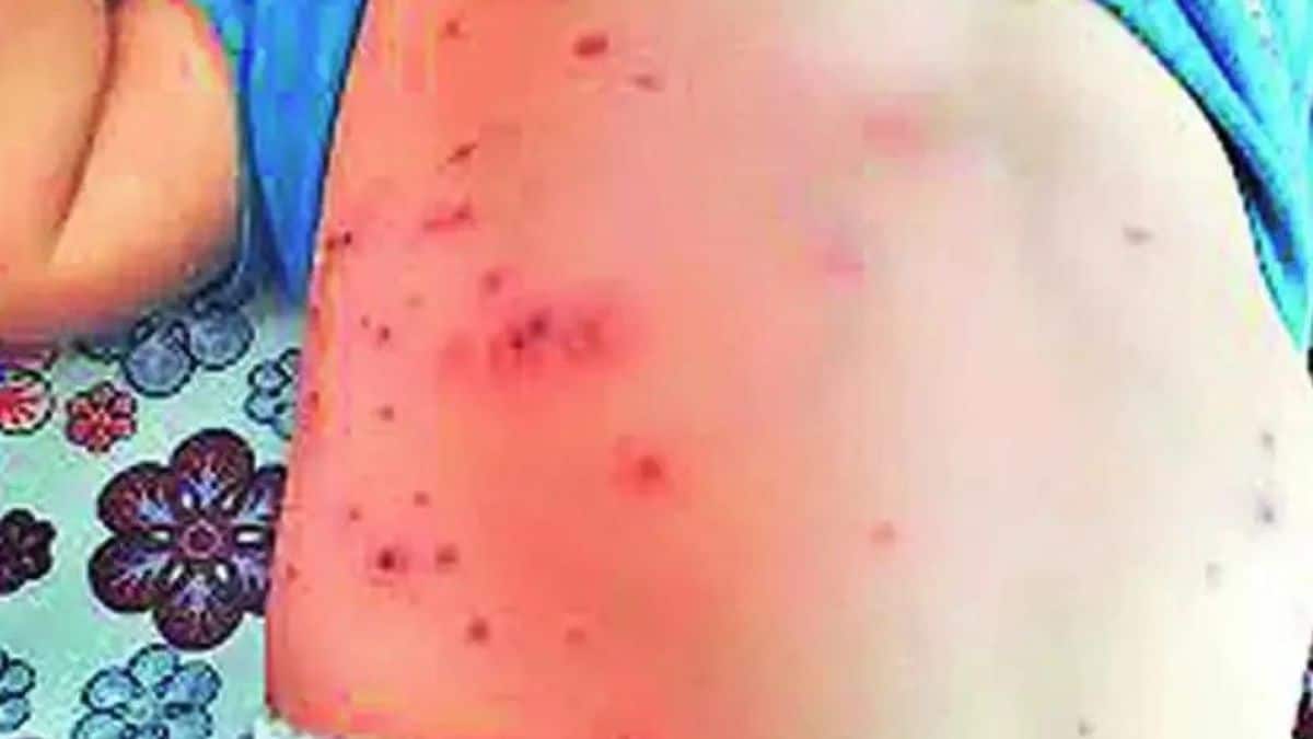 Risk of Scrub Typhus increased