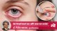 Conjunctivitis