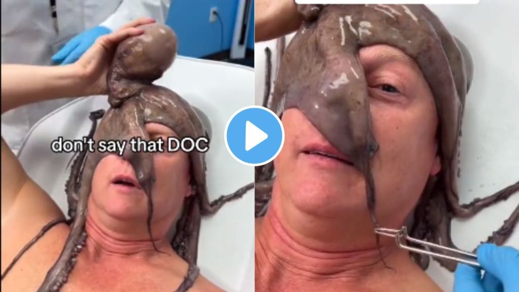 Octopus wrapped around the face of a person who had gone to bathe in the sea
