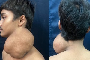 1.5 kg tumor on neck, tumor from neck removed after surgery