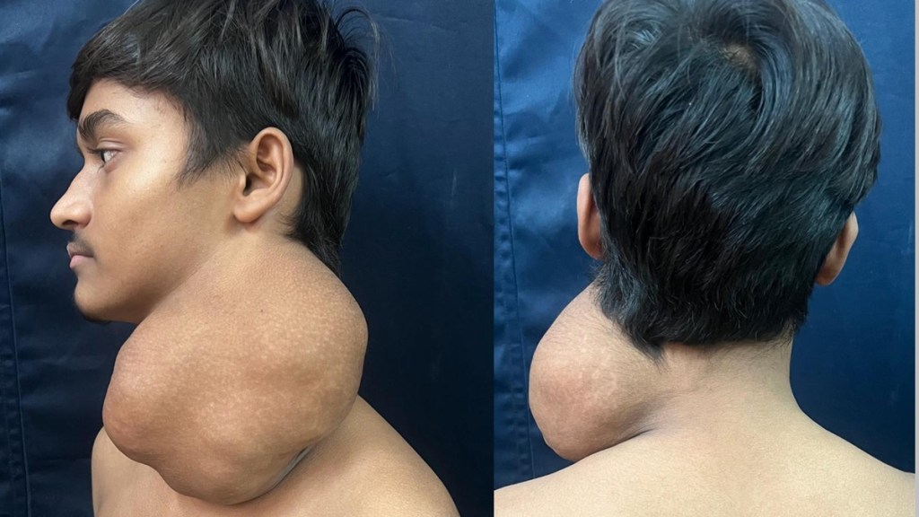 1.5 kg tumor on neck, tumor from neck removed after surgery