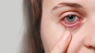 Maharashtra outbreak conjunctivitis under control mumbai