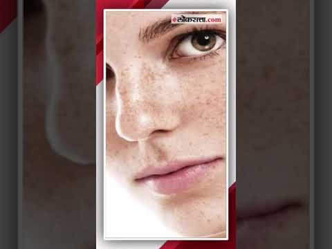 Do you suffer from pigmentation Learn from the experts