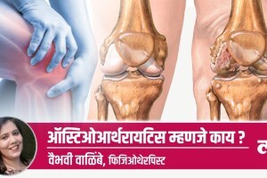 What is osteoarthritis