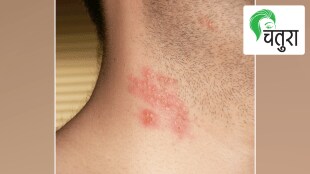 Superstition Herpes zoster Dermatitis, Ayurvedic remedies cure