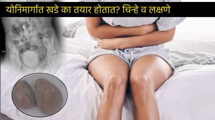 27 Year Old Lady had Orange Sized Stone In Vagina Same Like Kidney Stone Check Signs Of Urine Stone In Vagina Care In Marathi