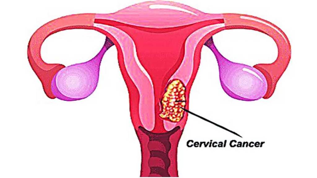 article about cervical cancer