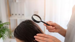 winter hair care secrets expert tips to get rid of dandruff with alma curd neem and turmeric