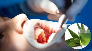 From decayed teeth to bad breath, use aloe vera for oral hygiene problems Know the benefits