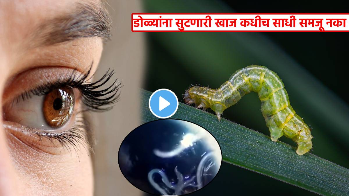 60 Alive Worms Removed From Womens Eyes After She Complains Itching In