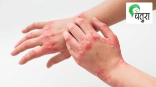 Psoriasis rise recently junk fast food, ayurvedic remedies dermatitis