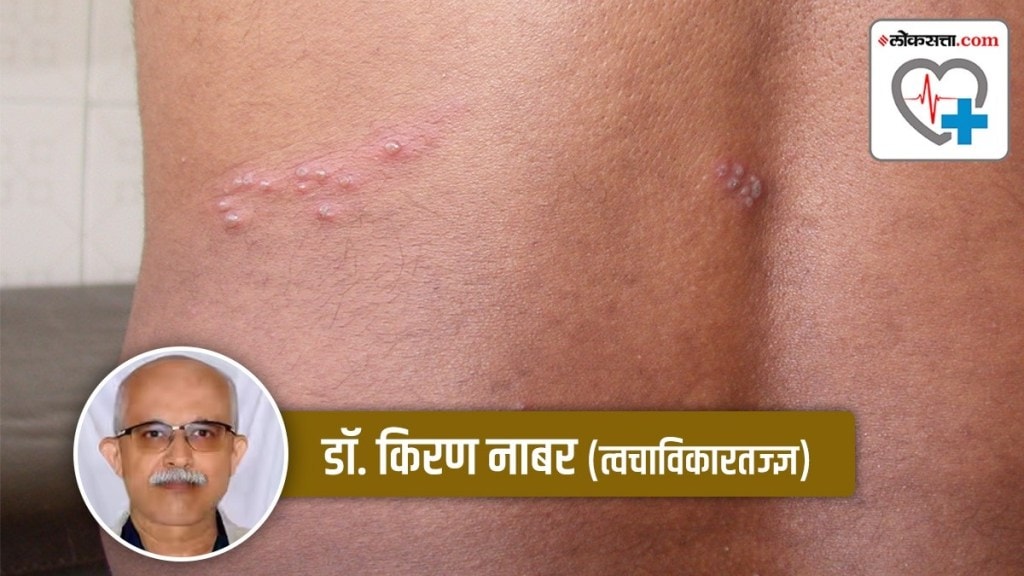 herpes zoster shingle infection in marathi, shingle infection in marathi, herpes zoster shingle in marathi