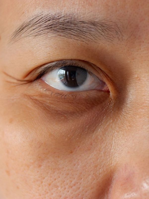 Try these 'quick' tips to prevent under-eye dark circles