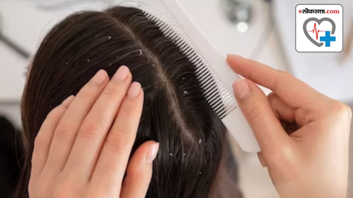 Dandruff in Winter