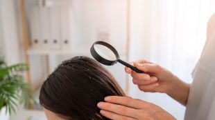 use 5 tips to get rid of dandruff in winter season