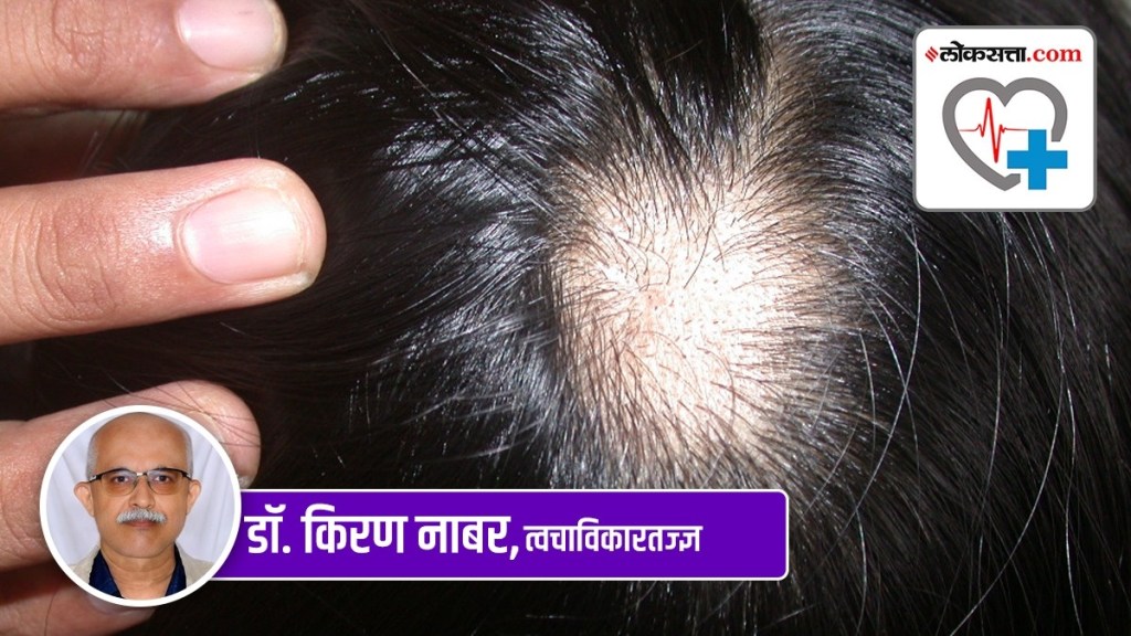 alopecia areata marathi news, alopecia areata disease marathi news, alopecia areata news in marathi