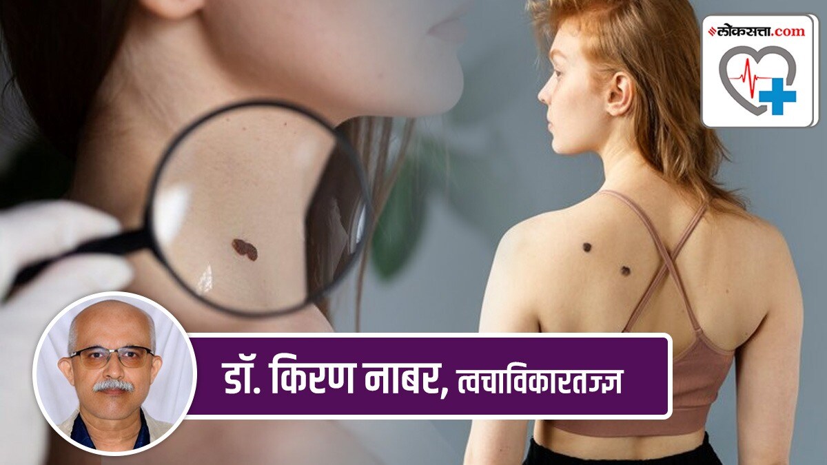 Have moles on your face what will you do
