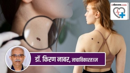 Have moles on your face what will you do