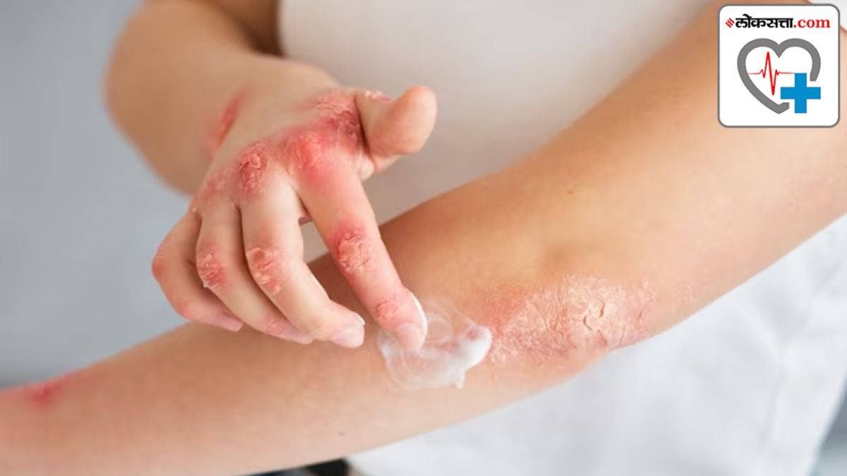 weight loss is helpful in psoriasis treatment