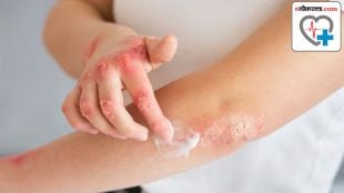 weight loss is helpful in psoriasis treatment