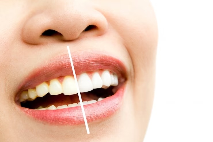 Teeth cleaning tips Home Remedies health tips