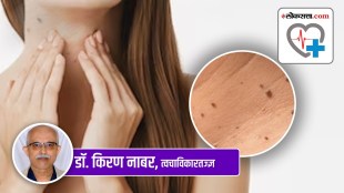skintags marathi, skintags treatment marathi, how to remove skintags marathi, how to remove warts marathi,