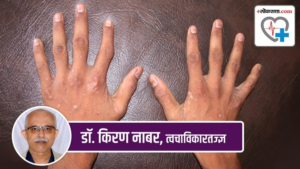 scabies marathi news, scabies symptoms marathi news,