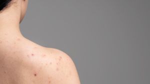 Back acne घालवण्याचे सोपे घरगुती उपाय! काय करावे, काय नको जाणून घ्या ‘या’ टिप्स….