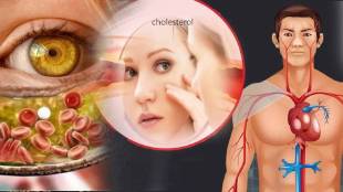 Bad Cholesterol Increased Shows Signs On Face Skin