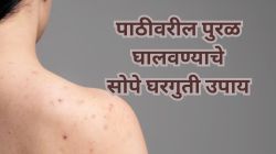 पाठीवरील पुरळाने केलंय तुम्हाला हैराण? Back acne कमी करण्यासाठी पाहा हे घरगुती उपाय….