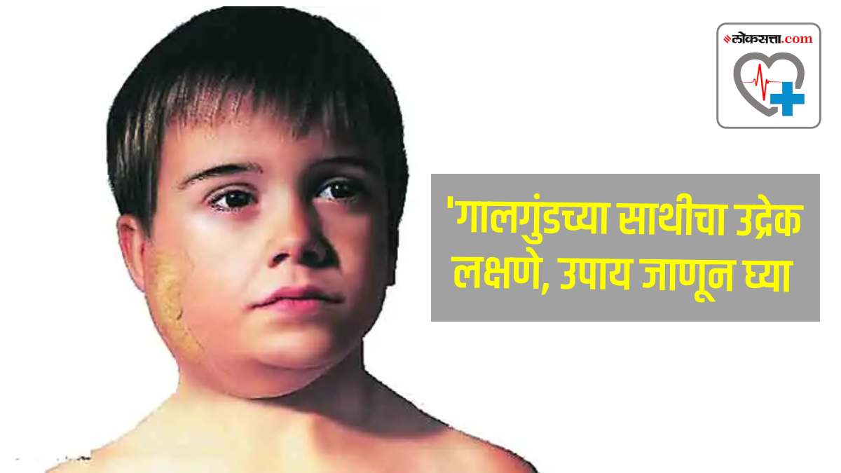 Kerala mumps outbreak Heres How do you treat mumps and vaccinate yourself