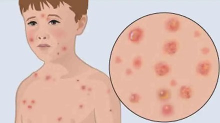 nagpur chickenpox marathi news, nagpur chickenpox spread marathi news