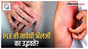 What are the symptoms of PLE disease also known as sun allergy