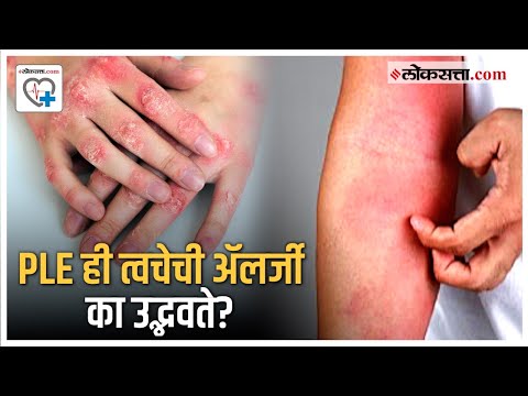 What are the symptoms of PLE disease also known as sun allergy