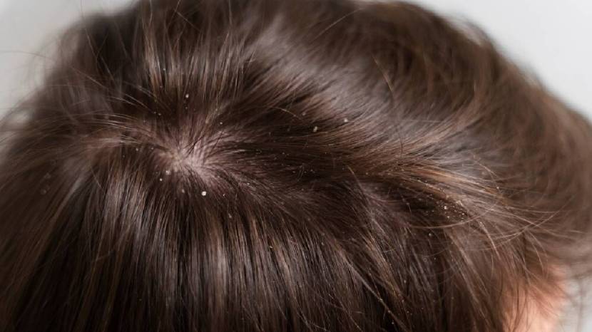 Five DIY Or Natural Hair Mask To Help Or Get Ride Of Dandruff Try This Home Remedies 