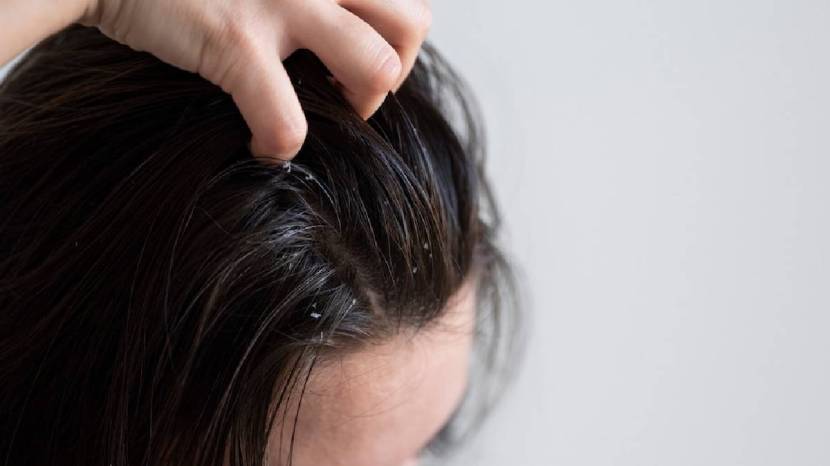 Five DIY Or Natural Hair Mask To Help Or Get Ride Of Dandruff Try This Home Remedies 