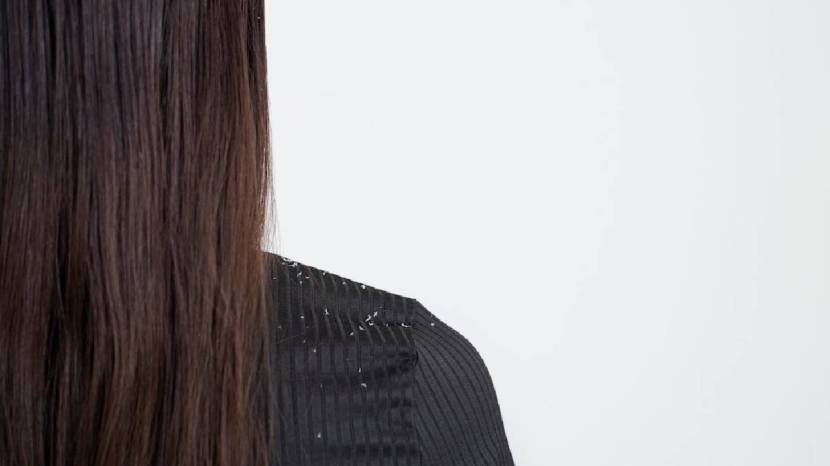 Five DIY Or Natural Hair Mask To Help Or Get Ride Of Dandruff Try This Home Remedies 