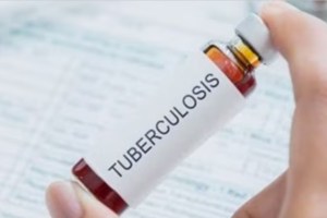 tuberculosis tb medicines marathi news