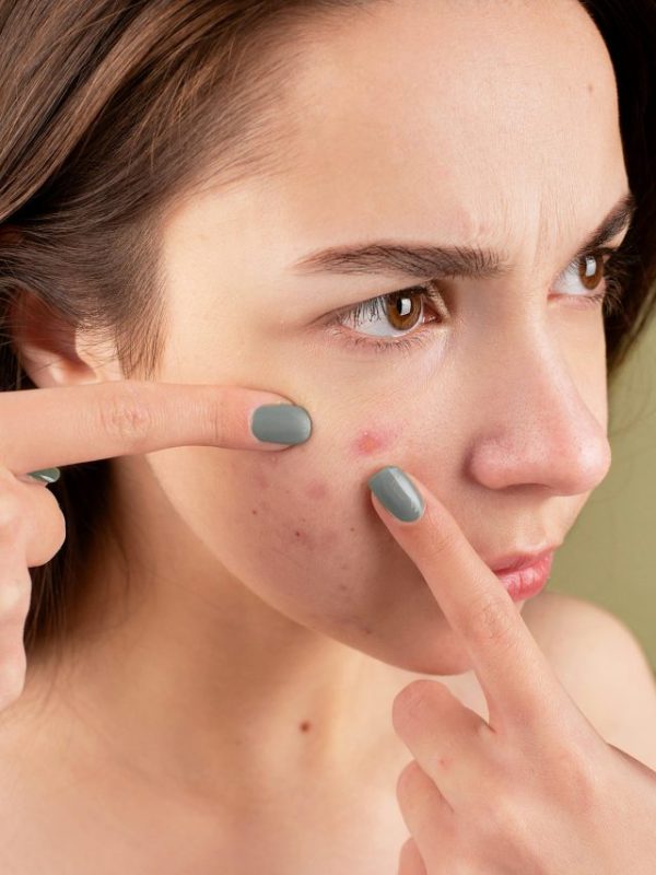 acne scars removal