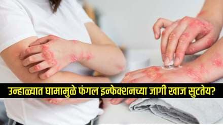 diy natural remedies for fungal skin infections simple bath 5 home remedies for fungal infection