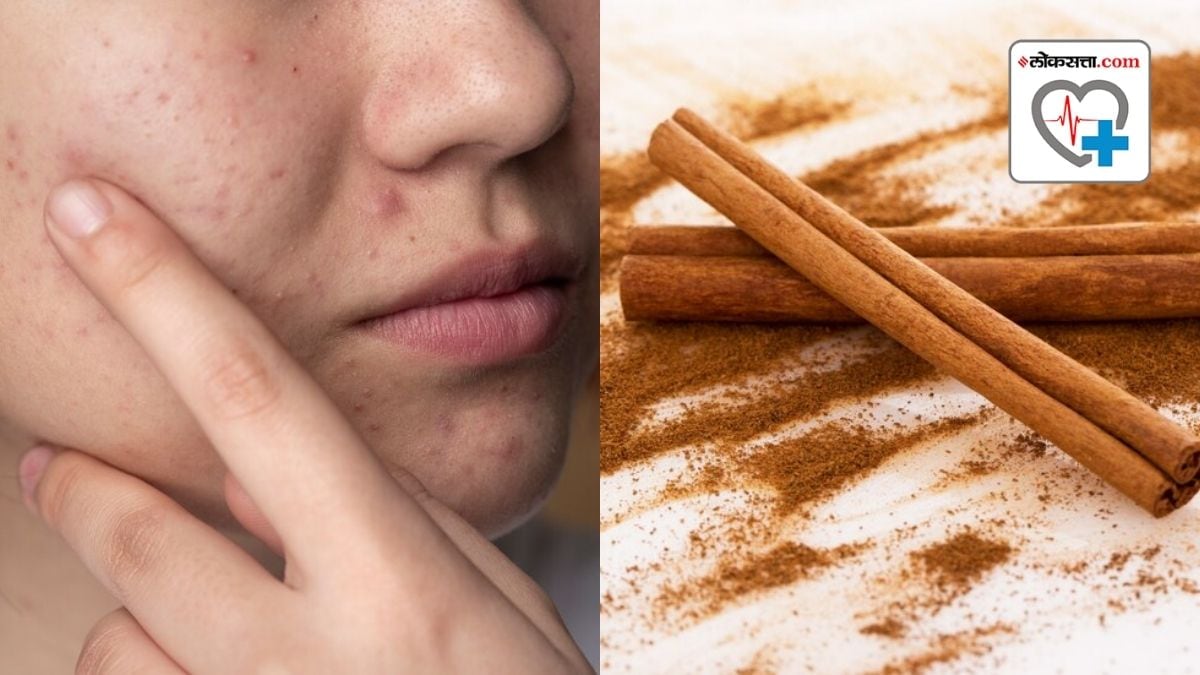 Can cinnamon treat acne