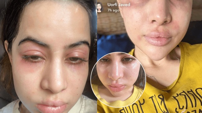 Urfi Javed shared an allergy photo with a swollen face said doing Botox since 18 years old