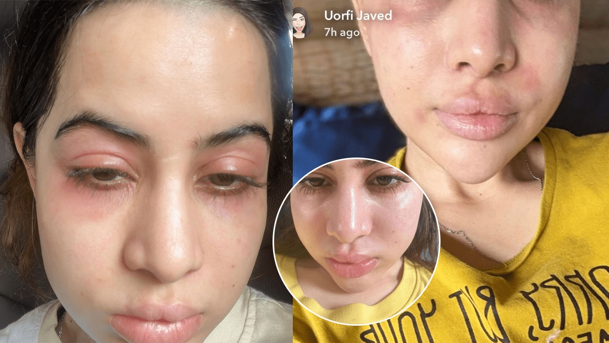 Urfi Javed shared an allergy photo with a swollen face said doing Botox since 18 years old
