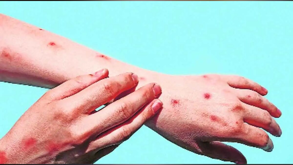 pune doctors spread rumours of monkeypox